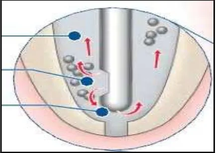 Gambar 11. Jarum irigasi yang tidak tersangkut dapat menyediakan ruang untuk aliran larutan NaOCl ke koronal30 