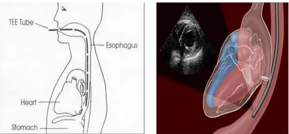 Gambar 4. Proses pemeriksaan secara Trans Esophageal Echocardiography (TEE) 