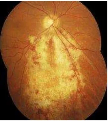 Gambar 8. Gambaran funduscopi retinitis CMV 25 