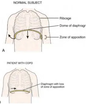 Gambar 1. A. Pada manusia normal, bagian bawah dari diafragma terletak berlawanan dengan bagian bawah iga (zona aposisi), sebagaimana yang ditunjukkan oleh tanda panah