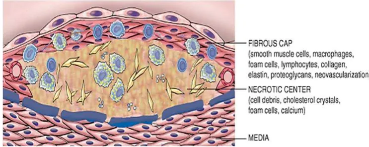 Gambar 6 : Morfologi plak aterosklerotik 12