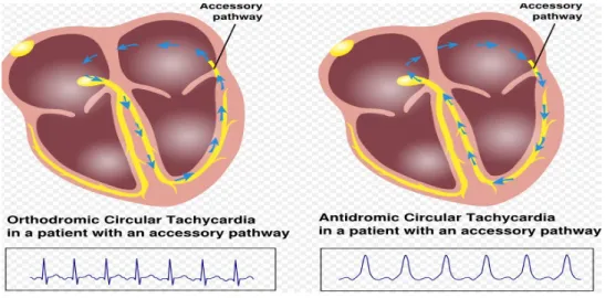 Gambar 2.4 Gambaran AVRT orthodromic dan antidromic 3. Atrioventricular nodal re-entry tachycardia (AVNRT)