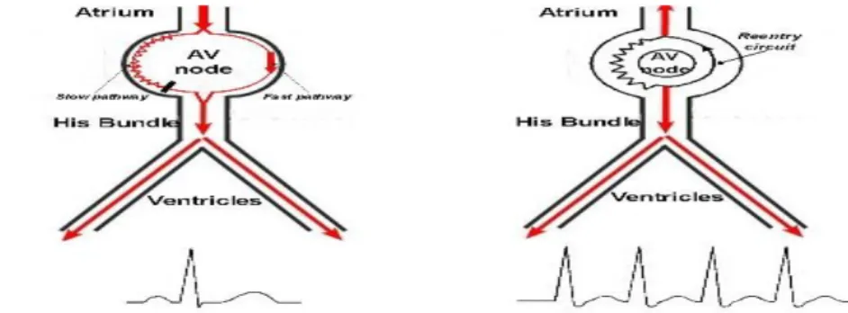 Gambar 2.5 Gambaran reentry pada AVNRT
