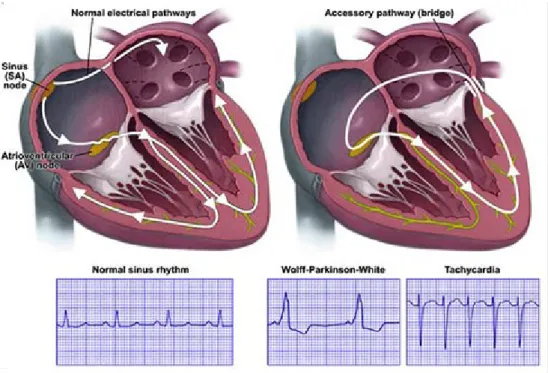 Gambar 2.2 Gambaran accessory pathway pada sindrom WPW