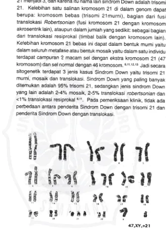 Gambar 1.Kariotip laki-laki penderita sindrom Down trisomi 21 yang mempunyai 3kromosom 21 (Faradz SMH, 1996)