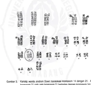 Gambar 3. Kariotip wan ita sindrom Down translokasi kromosom 14 dengan 21. Ada 3kromosom 21 yaitu satu kromosom 21 berikatan 