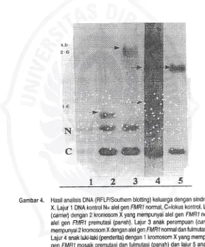 Gambar 4. Hasil analisis DNA (RFLP/Southem blotting) keluarga dengan sindrom fragileX