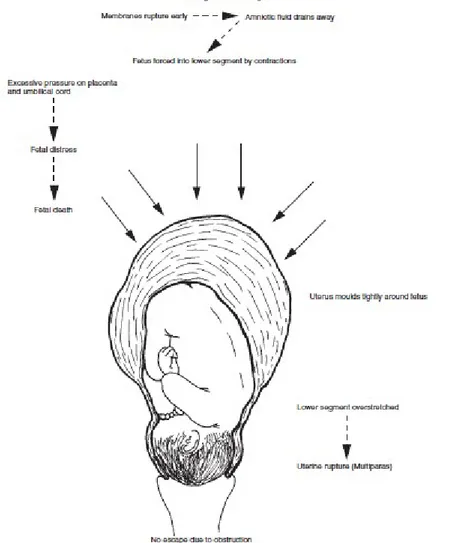 Gambar 2.1. Patofisiologi Uterus Pada Persalinan Lama 1