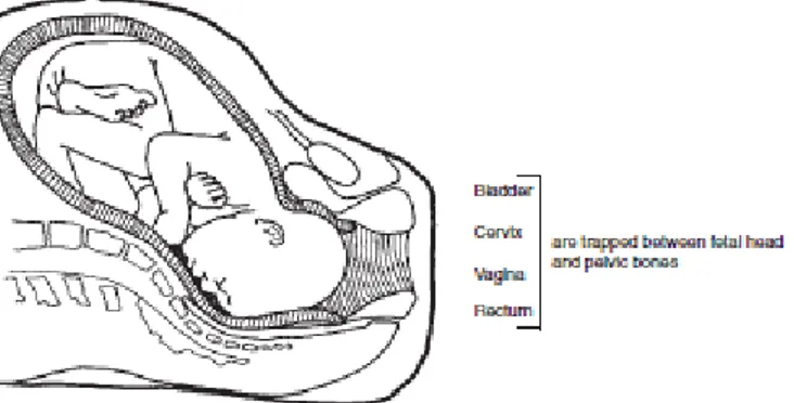 Gambar 3. Komplikasi Fistula Pada Kala II Lama 1