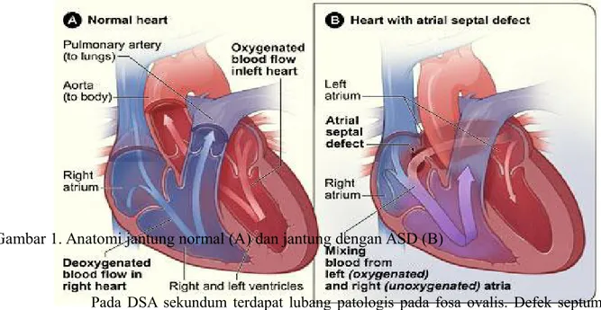 Gambar 1. Anatomi jantung normal (A) dan jantung dengan ASD (B)