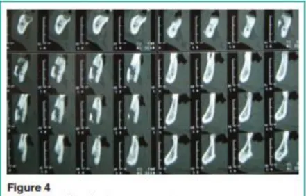 Gambar 4. CBCT yang memperlihatkan tulang sequestrum  