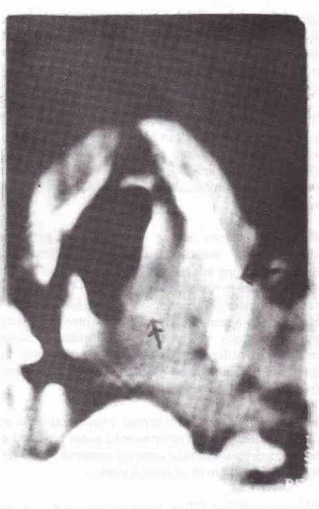 Figure 1. tlispLacement distance. Axial CT (glottic level); growth involving the vocalcord, exlension lateral to the arytenoid cartilage, medialof the arytenoid and widened thyro-arytenoidNotice there is also invasion ofthe.thyroid cartilage.