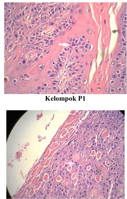 Gambar / foto sel mitosis pada jaringan karsinoma epidermoid (anak panah merah 