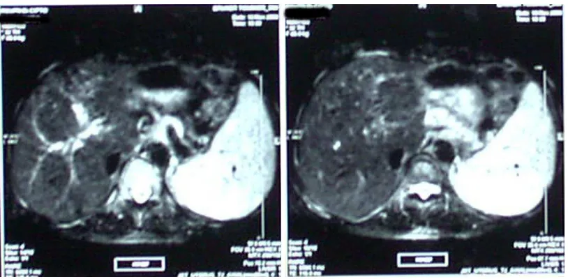 Figure 1. MRI abdomen showing splenomegaly and fatty liver 