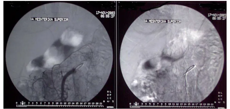 Figure 2. a The arterial phase of celiac angiography showed dilatation of splenic artery