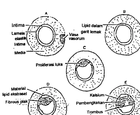 Gambar I. Tingkat kerusakan arteri pada arterosklerosis (Frohlich 1976) 