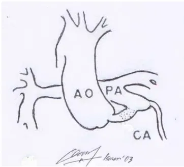 Figure 1. The schematic illustration of Coronary to pulmonary fistula. AO: aorta, PA: Pulmonary artery, CA: coronary artery 