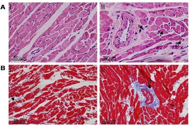 Gambar 3. Gambaran miokard normal dan fibrosis pada jaringan miokard12 