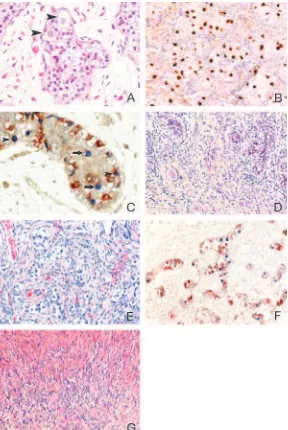 TABLE 3. Summary of staining results in the encounteredgonadal differentiation patterns and in gonadoblastoma(GB)/dysgerminoma (DG)