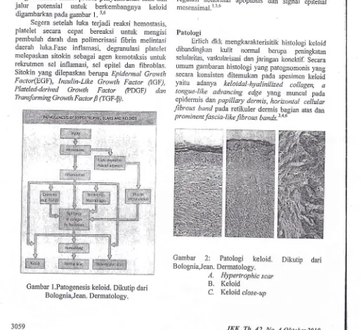 Gambar 2: Patologi keloid. Dikutip dariBolognia,Jean. Dermatology.
