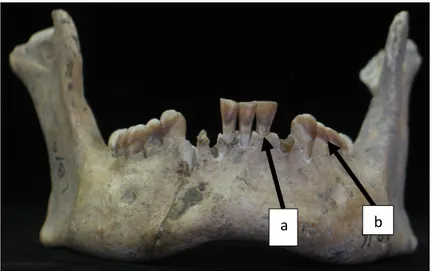 Gambar 6. Liang Bua. A= Periodontitis, B=Pewarnaan (Dental Stain)   (Sumber: Foto Koleksi Pribadi)  