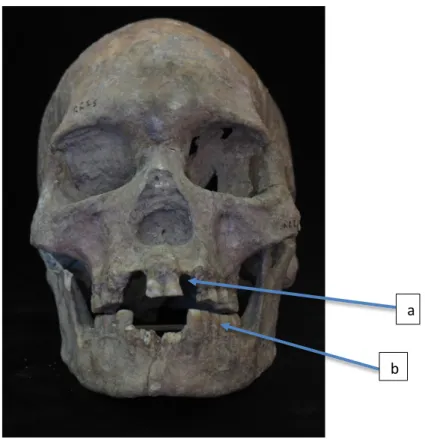 Gambar 2. Individu LL 1.5. A=Praktik modifikasi gigi. B=dental stain  (Sumber: Foto Koleksi Pribadi) 