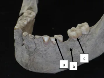 Gambar 3. Individu LL 1.3. A= Atrisi, B=Antemortem Tooth Loss (AMTL) dan C=Pewarnaan  (dental stain) 
