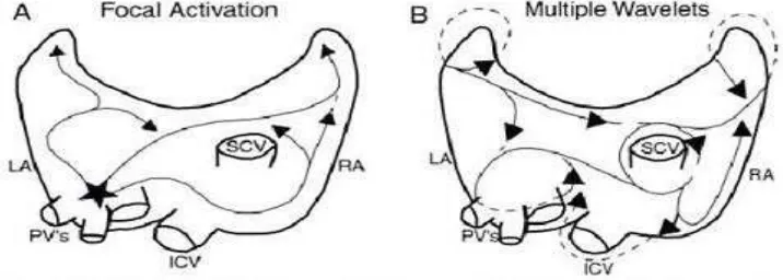 Gambar 3. A. Proses aktivasi fokal atrial fibrilasi dan B. Proses Multiple 