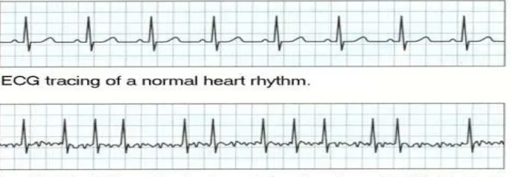Gambar 1. Contoh gambaran irama jantung normal dan atrial fibrilasi 