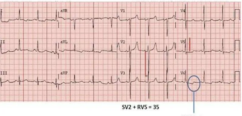 Gambar 4. Gambaran EKG pada Hipertrofi Ventrikel Kiri 