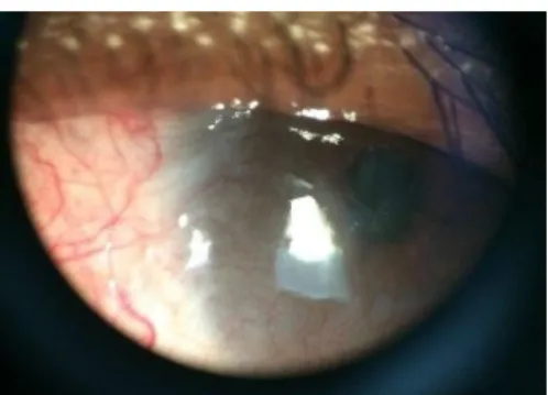 Gambar 2.2 Konjungtivalisasi dan neovaskularisasi pada mata kiri 