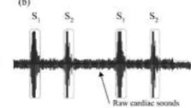 Gambar 3.11 Usual Normal Heart Sound 
