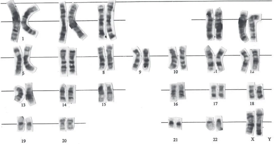 Figure 1. Normal male karyotype: it consists of  22 pairs of autosome and 2 sex chromosomes (XY)