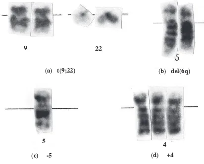 Figure 2. Examples of chromosomal abnormalities: (a) translocation (9,22) ; (b) 6q deletion ; (c) monosomy 5; (d) trisomy 4 