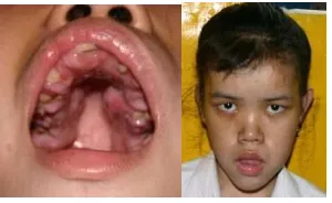 Figure 3. Picture of suspected Cowden syndrome patient. 