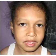 Figure 4. Picture of suspected Lujan syndrome patient. 