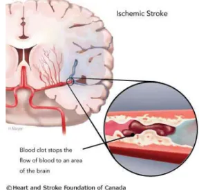 Gambar 2.1 Stroke Hemoragik   Gambar 2.2. Stroke Iskemik  (Sumber: Heart and Stroke Foundation of Canada) 