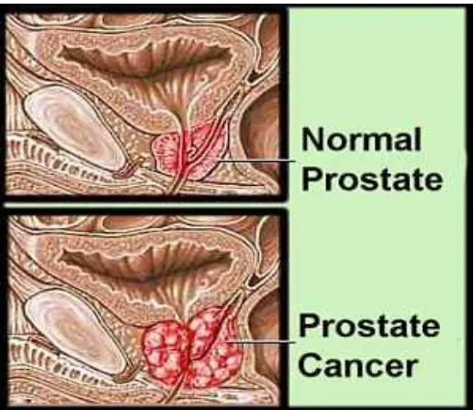 Gambar 2.1. Kanker Prostat 