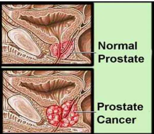 Gambar 2.1. Kanker Prostat 