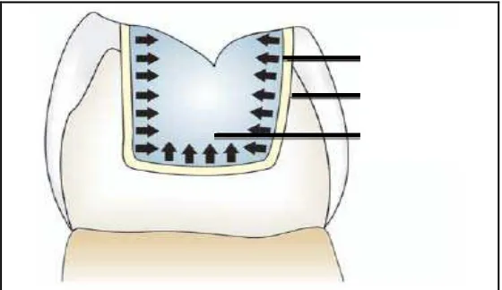 Gambar 7. Shrinkage polimerisasi menghasilkan celah   diantara bahan restorasi dan permukaan gigi.8  