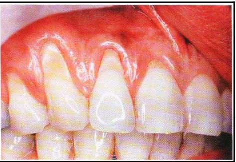 Gambar 1: Resesi pada daerah gigi insisivus hingga caninus (Carranza F, Newman, Takei, Klokkevold