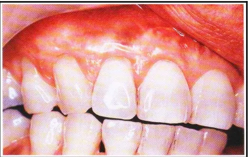 Gambar 5: Penutupan akar gigi setelah penyembuhan. (Carranza F, Newman, Takei, Klokkevold