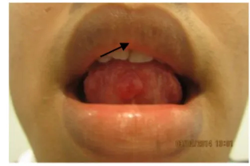 Gambar 2. Pandangan intra oral terlihat lesi pada ventral  lidah diameter 1 cm, sewarna jaringan sekitar, batas jelas,  kenyal dan bergerak