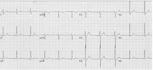 Gambar 2. Gambaran normal EKG 12 sandapan. Dikutip dari Yanowitz F G25