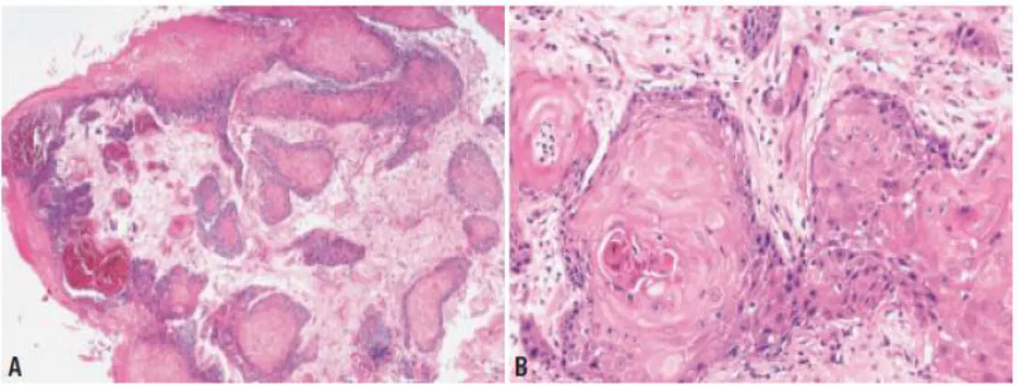 Gambar 2.4. Keratinizing squamous cell carcinoma. A. Invasi tumor kedalam stroma. B. Pulau-pulau  ireguler  dengan  stroma  desmoplastik  (dikutip  dari  Chan  JKC,Bray  F,  McCarron