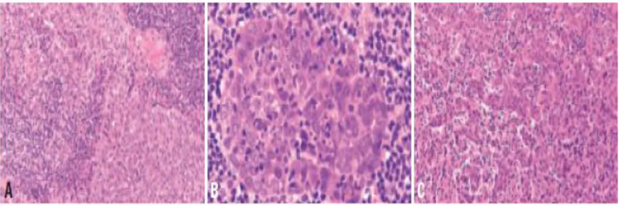 Gambar  2.5.  Non  keratinizing  carcinoma,  differentiated  subtype.  A.  Terdapat  lapisan-lapisan  tumor  yang  dipisahkan  oleh  limfosit  dan  sel-sel  plasma