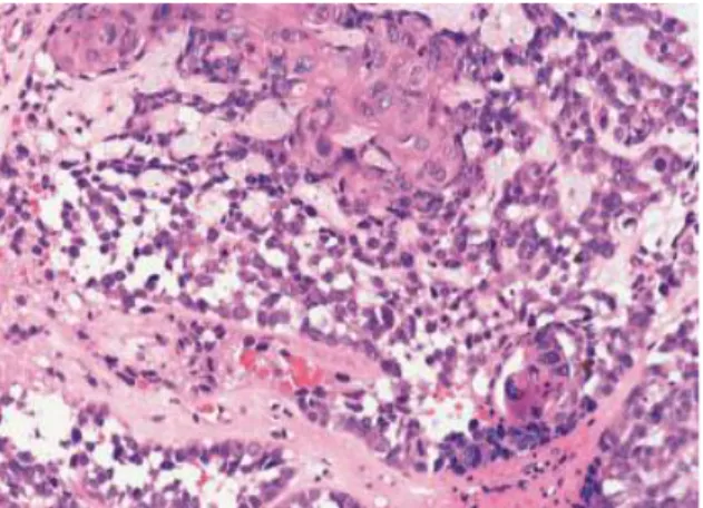 Gambar  2.8.  Basaloid  squamous  cell  carcinoma.  Sel-sel  basaloid  menunjukkan  pola  pertumbuhan  festooning,  sel-sel  basaloid  berselang-seling  dengan  diferensiasi  skuamosa  (dikutip  dari  Chan 