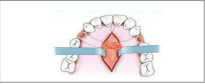Gambar 8. Midline sagital insisi dibuat untuk mengakses palatum untuk osteotomi. (Mani V
