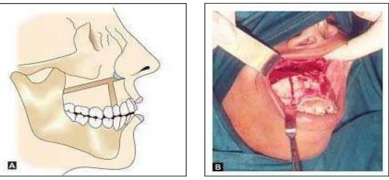 Gambar 9. Anterior rahang atas osteotomi sehubungan dengan Le Fort Ifoto. (Mani V.  osteotomi (A)diagram (B) Surgical correction of facial deformities.Mosby:Jaypee medical,2010: 112-4) 