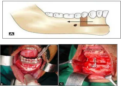 Gambar 11. Lower  subapicaldeformitiesosteotomy anterior osteotomy  (A) diagram (B) foto (C) Lower  subapical anterior   dapat dikombinasikan dengan genioplasty